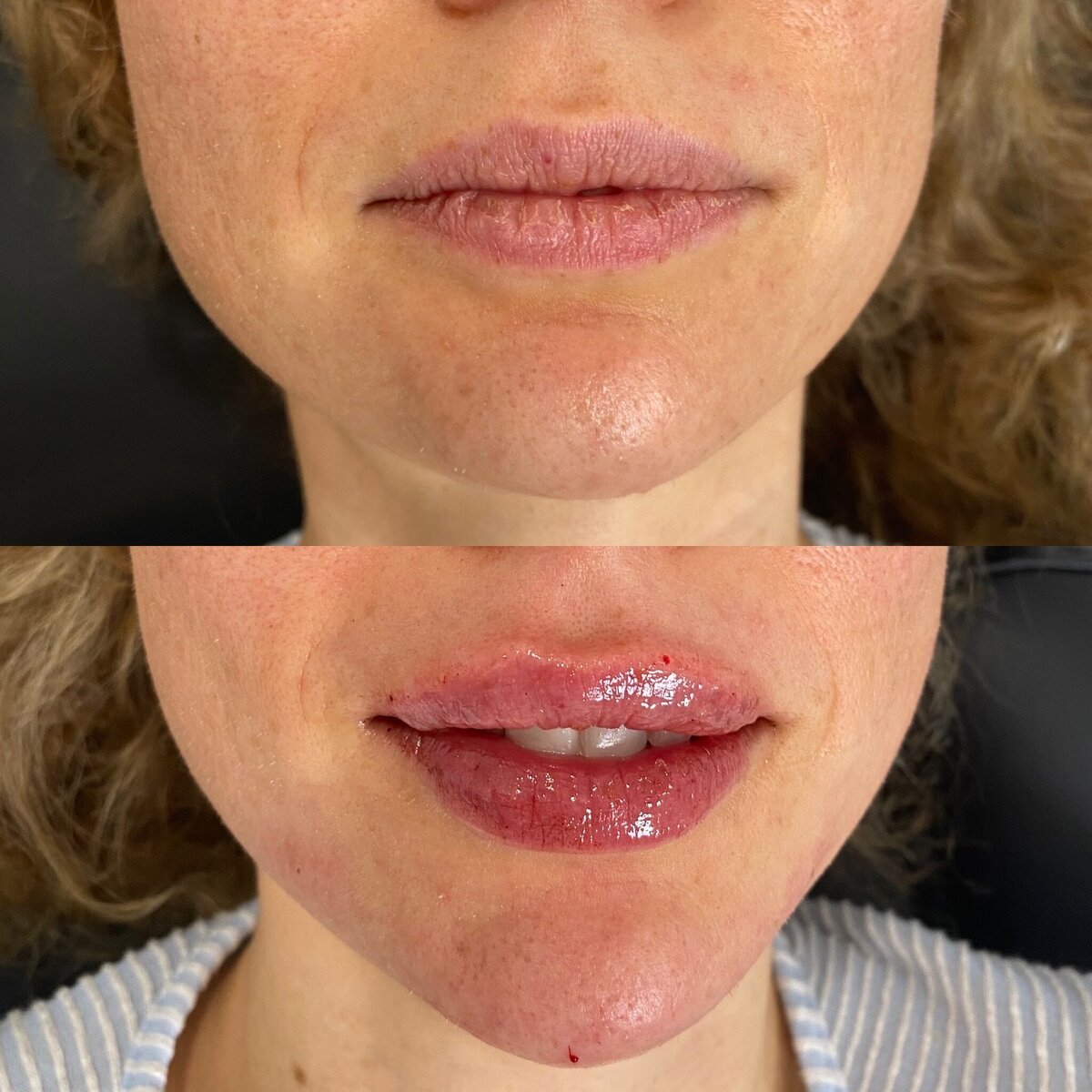 BalancedBeautyBotoxWestwood6