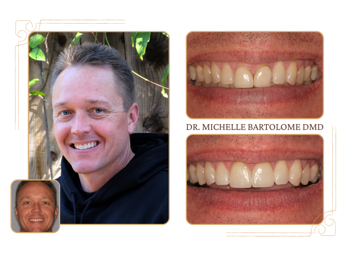 Front tooth teeth (2)