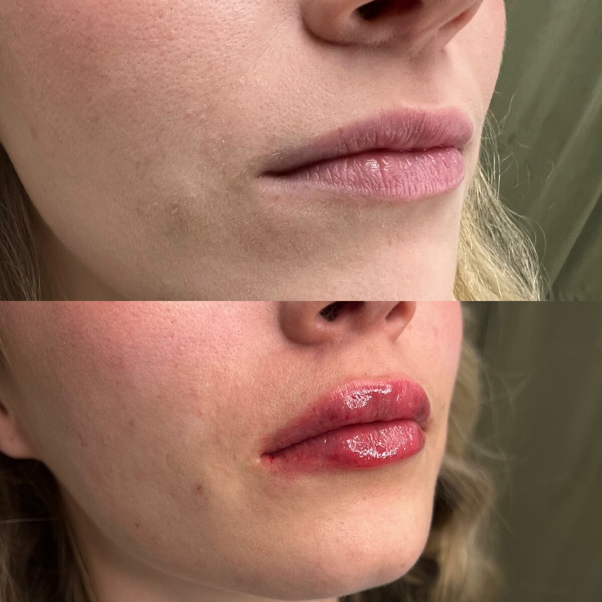 lip filler