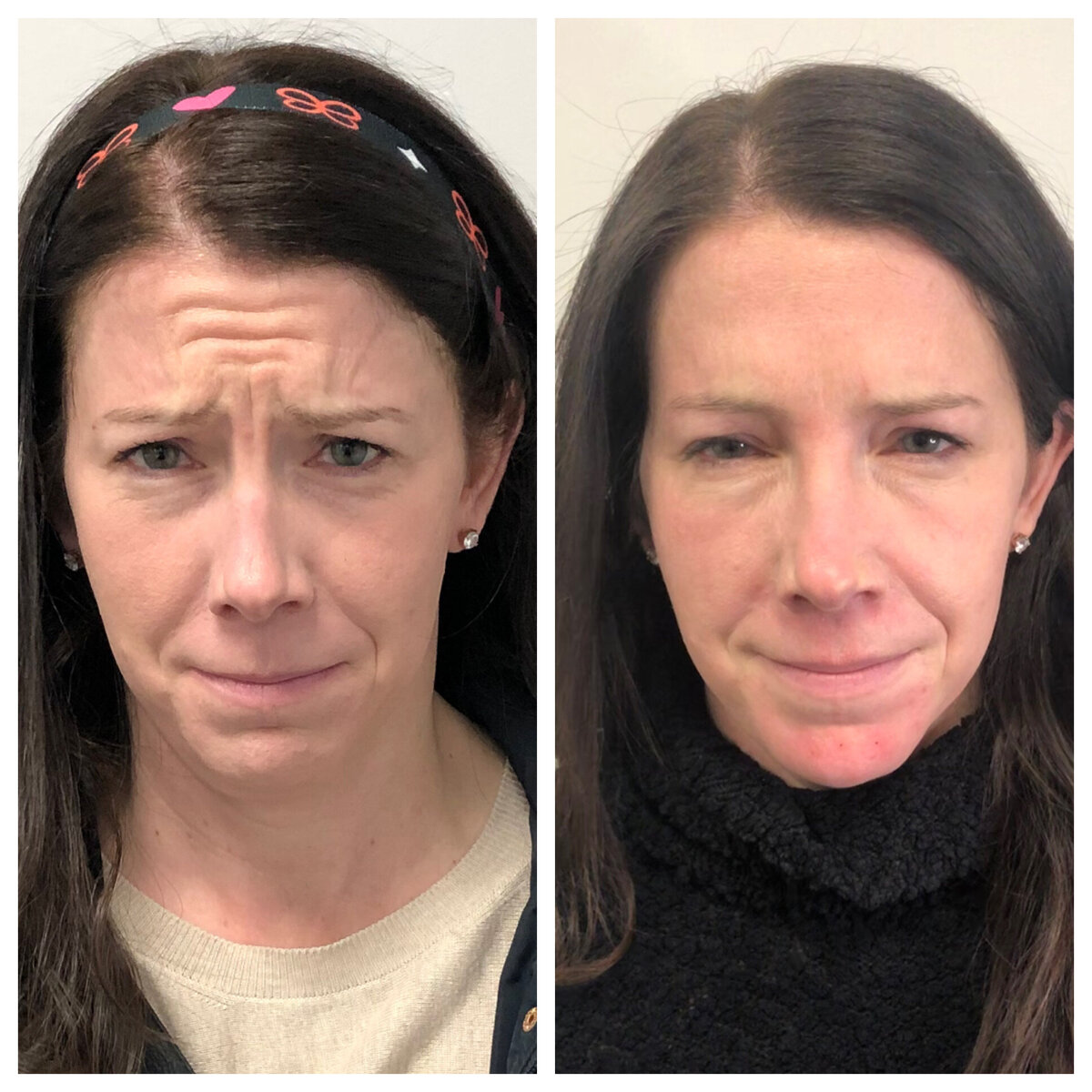 BalancedBeautyBotoxWestwood7