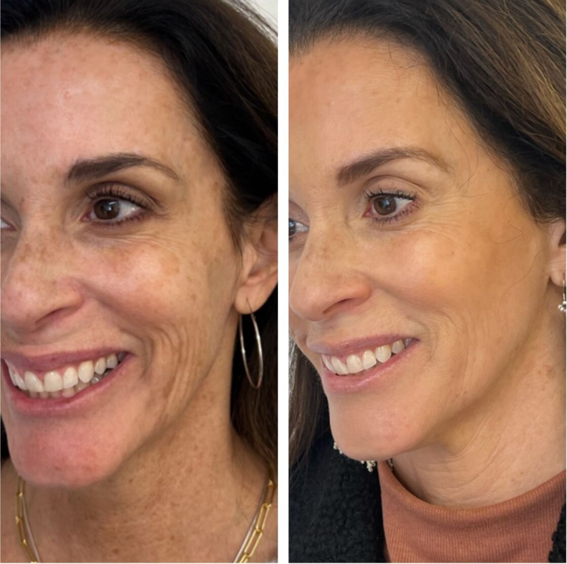 compressed-sculptra-before-after-03