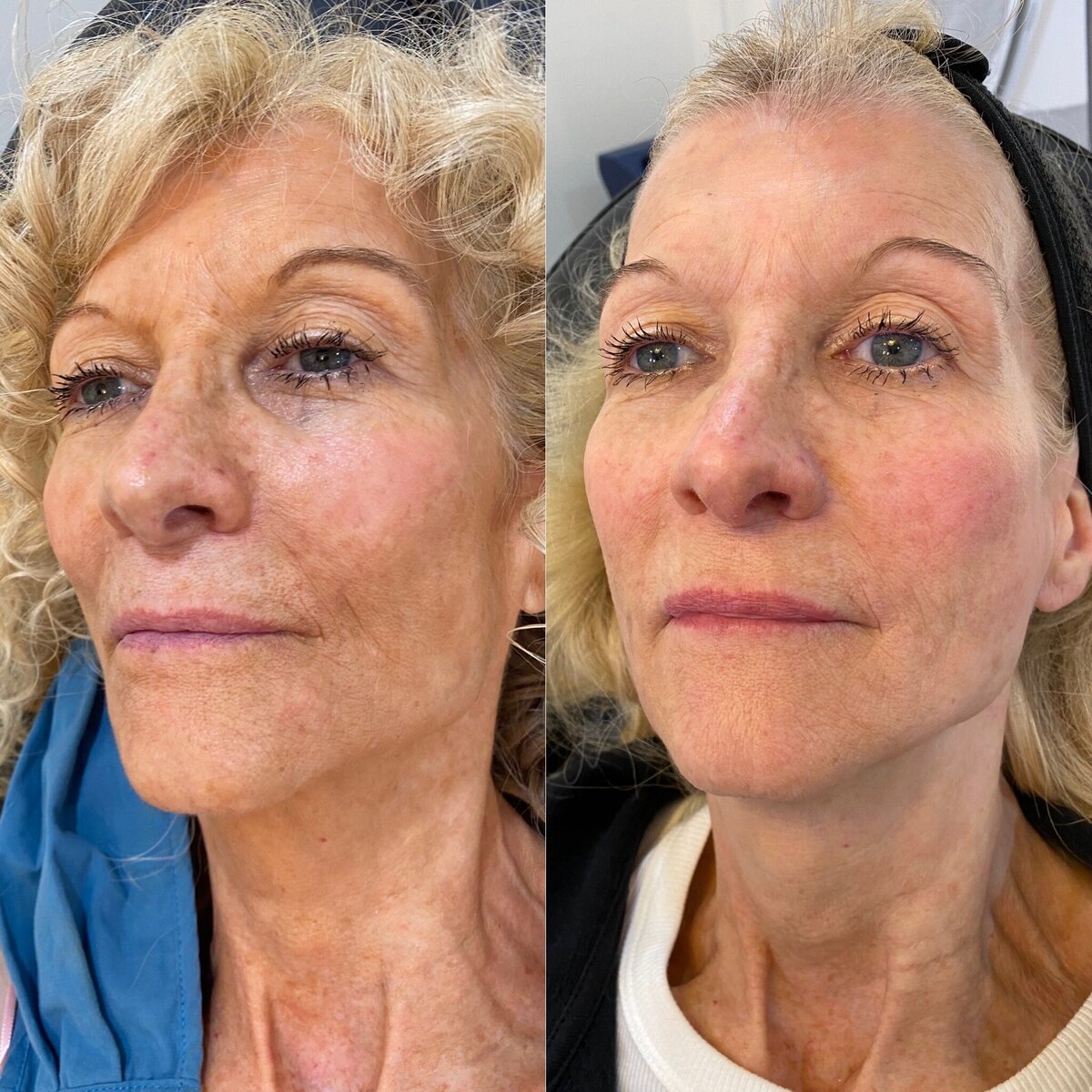 BalancedBeautyBotoxWestwood24