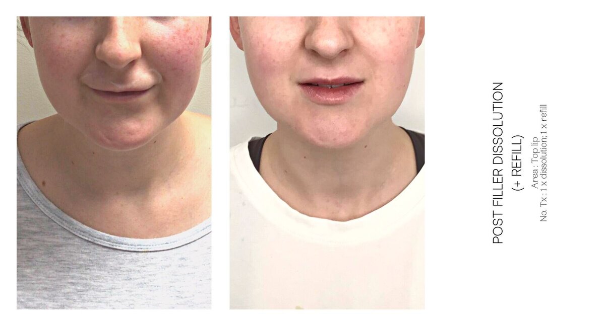 Top Lip Filler Dissolve Before and After 2