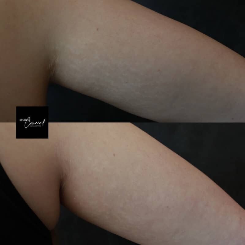 stretch-mark-arms-right-back-2