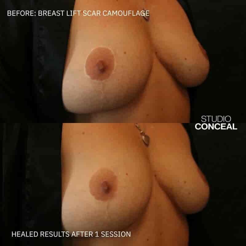 breast lift explant scar concealed