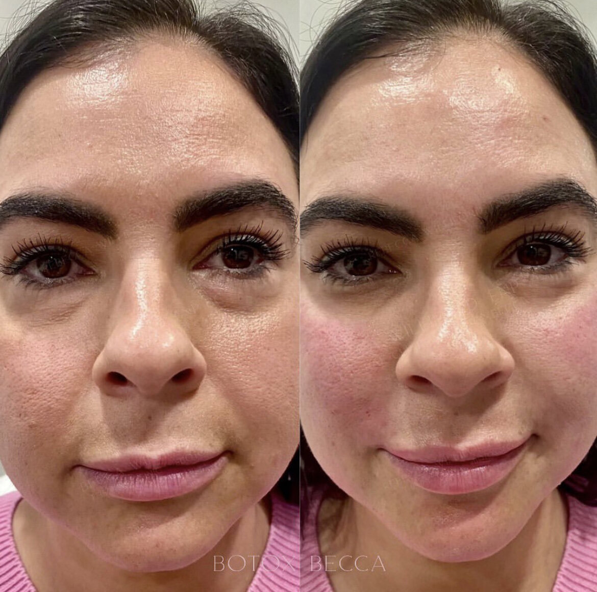 Botox by Rebecca Williford at The Rae Clinic in Augusta, Georgia