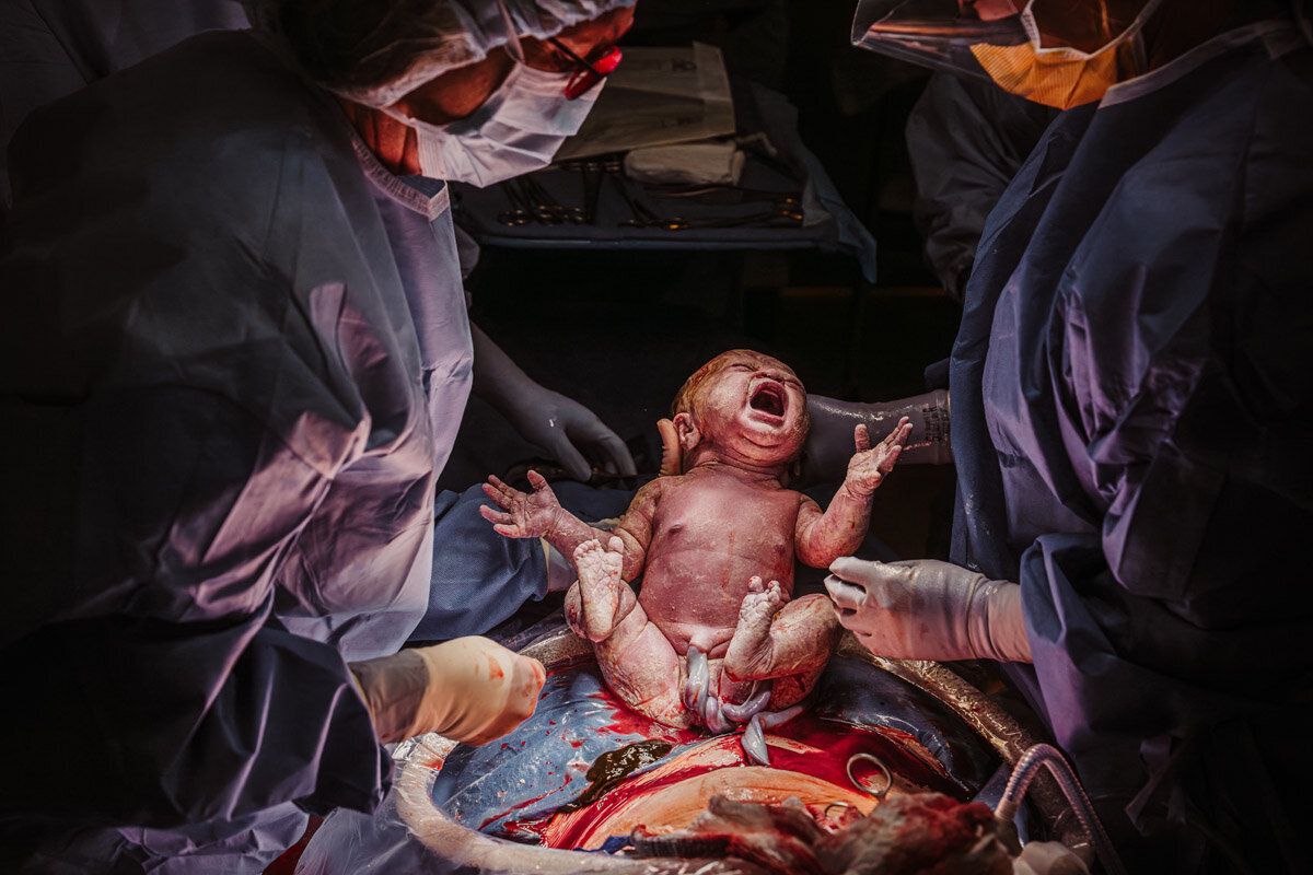 cesarean-birth-photography-natalie-broders-c-017