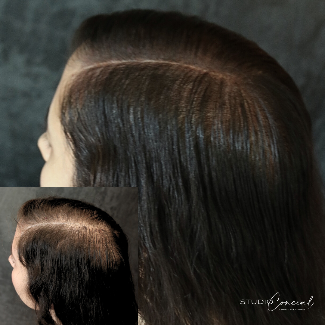female-hair-density-treatment-in-arizona-2