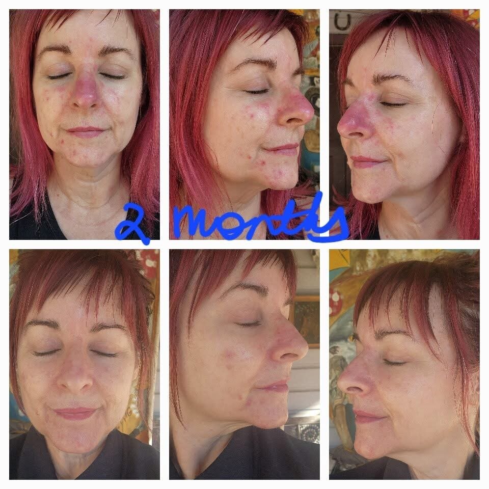 Before and after photos highlighting the reduction of nose swelling and skin thickening from phymatous rosacea
