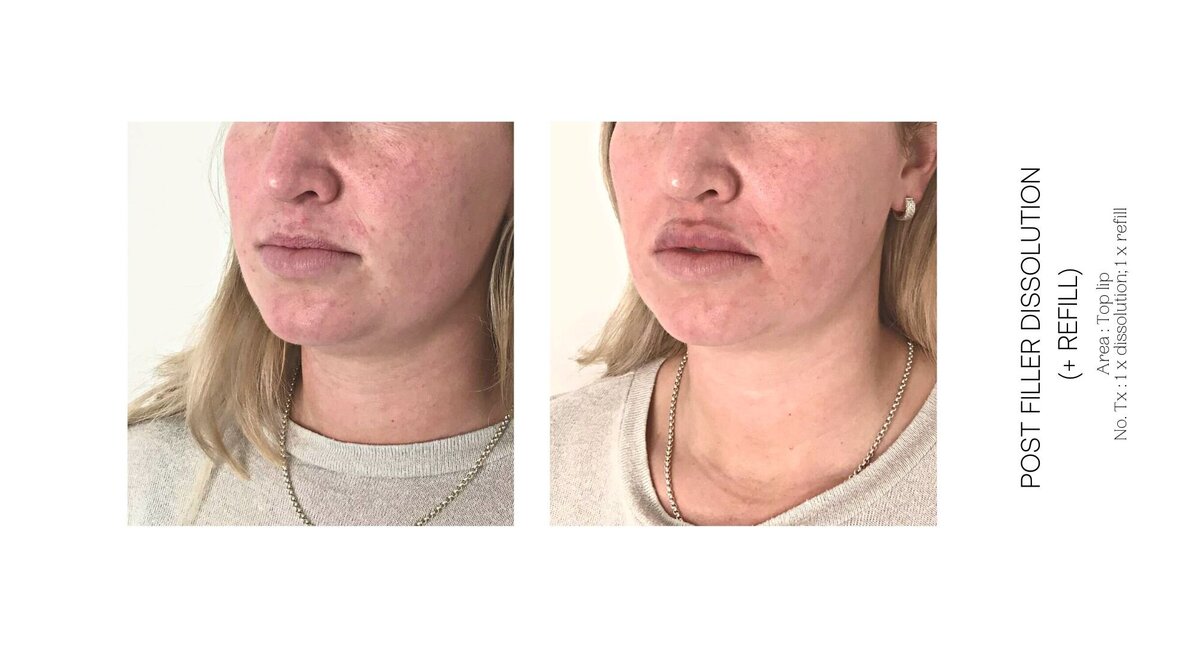 Top Lip Filler Dissolve Before and After 12