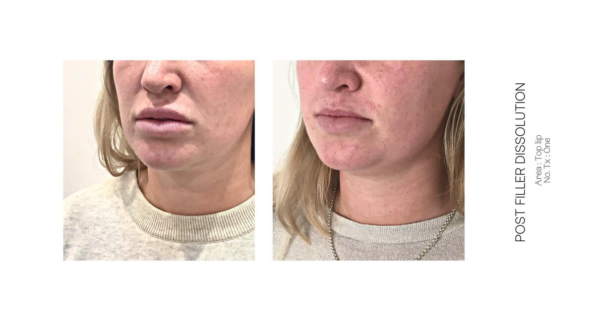 Top Lip Filler Dissolve Before and After 11