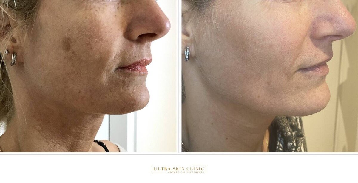 voor en na huidverbetering ultra skin clinic