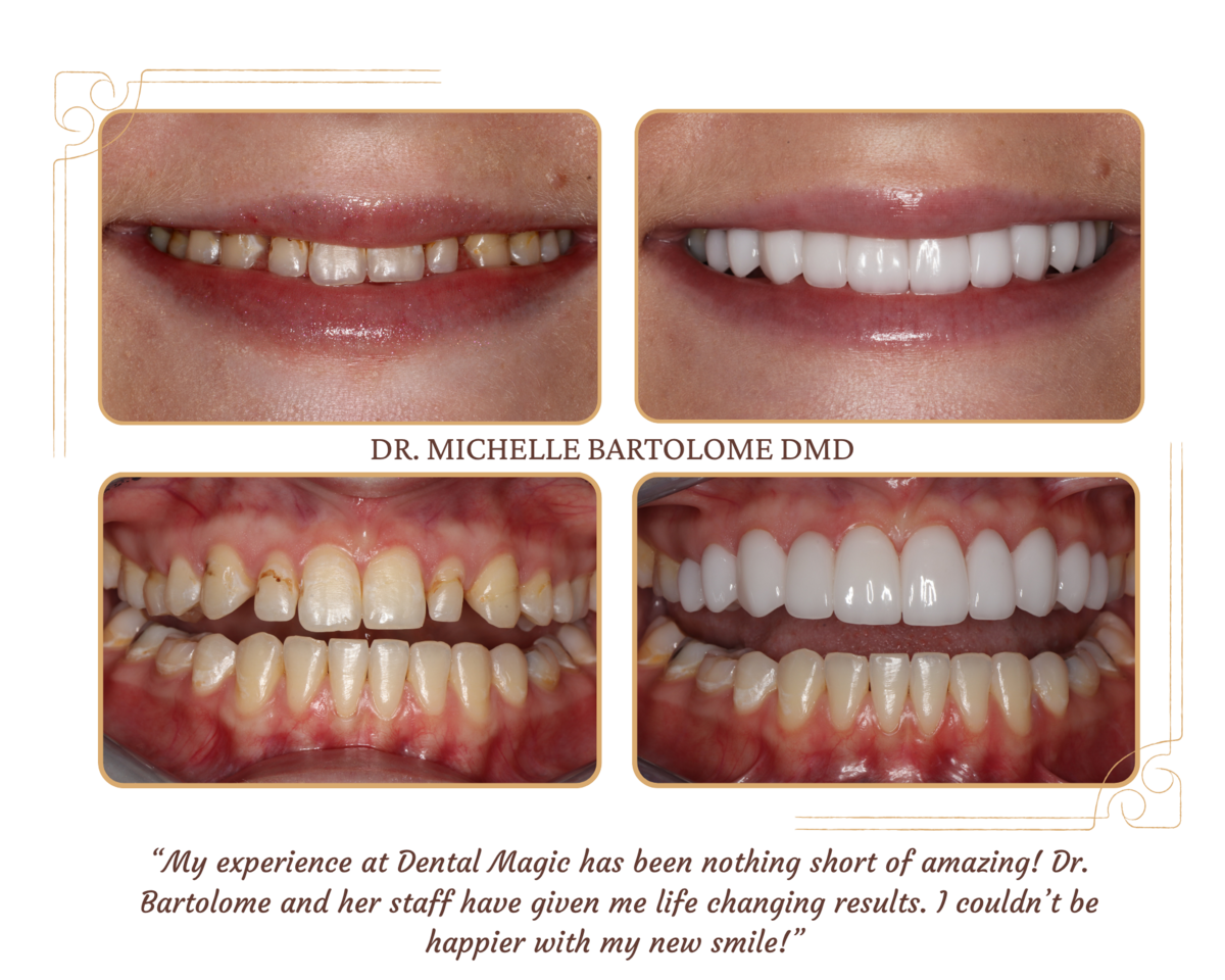 Porcelain Crowns and Veneers