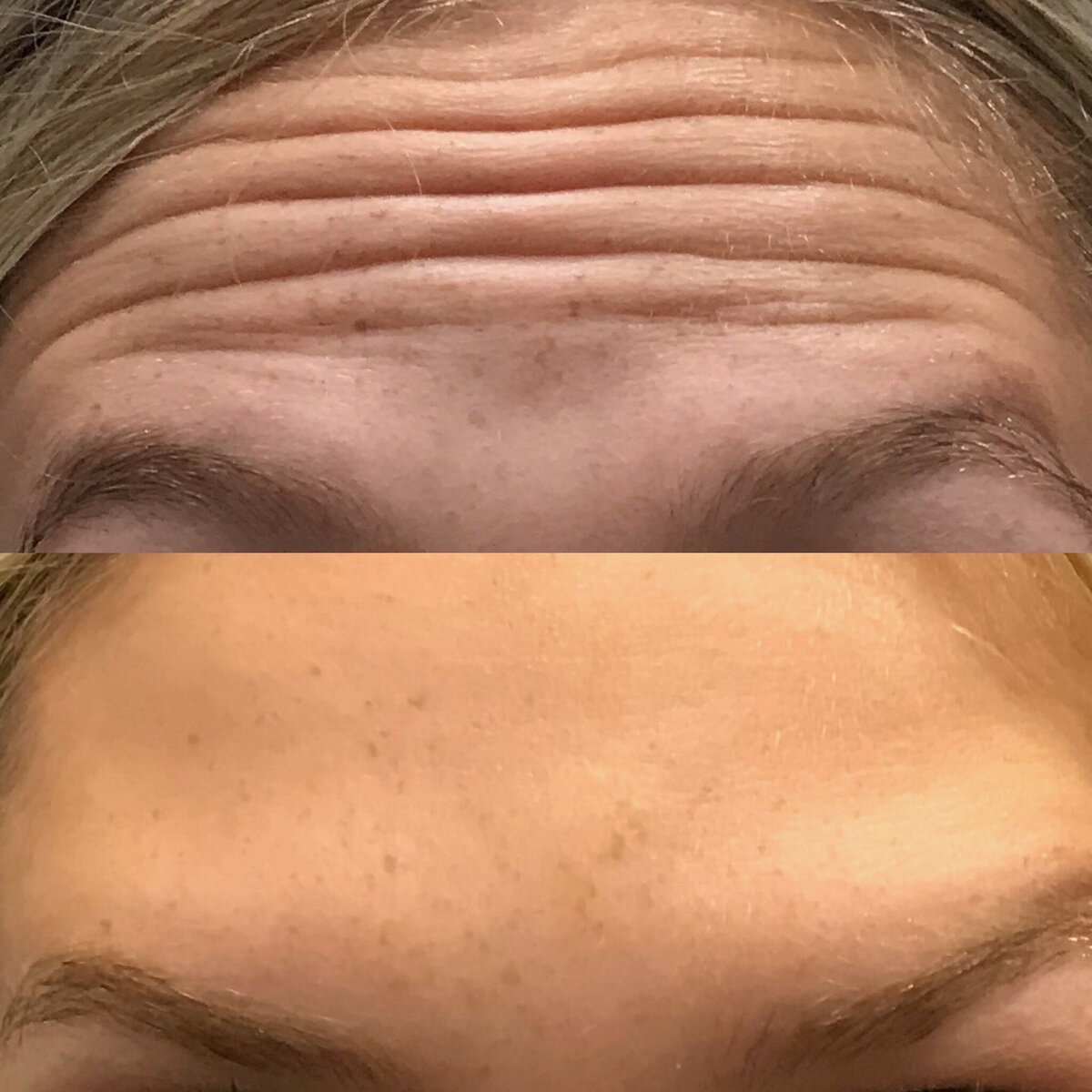Forehead to filler to remove wrinkles