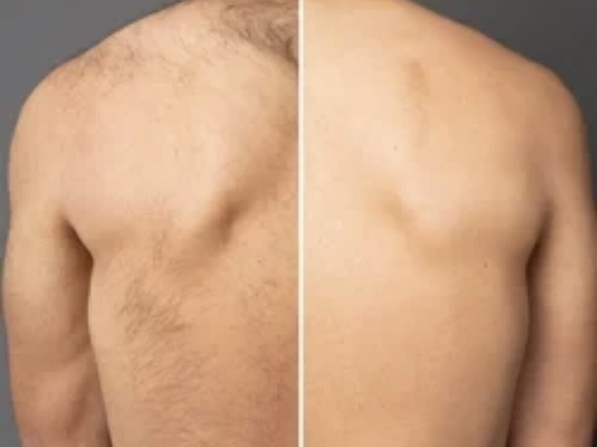 pre and post 4 treatment laser hair removal