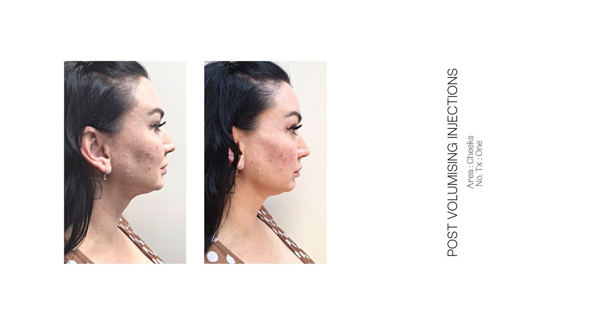 Cheek Injectable Before and After 11