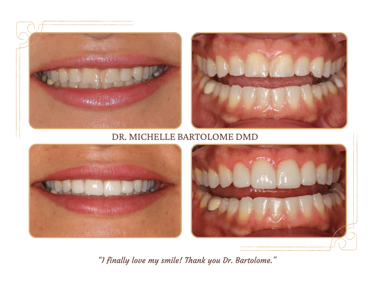 Front four porcelain crowns