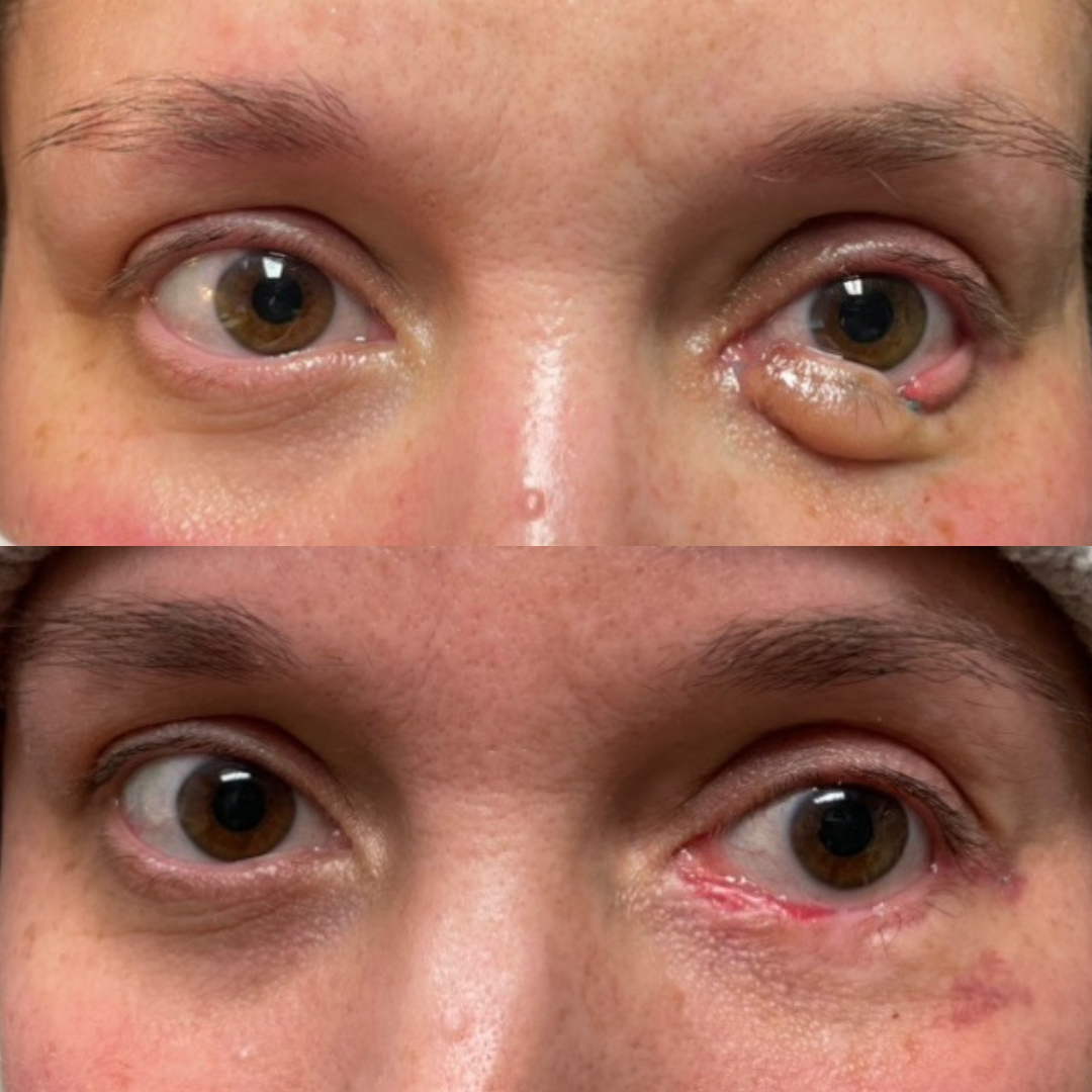 Lower eyelid reconstruction with a Hughes procedure