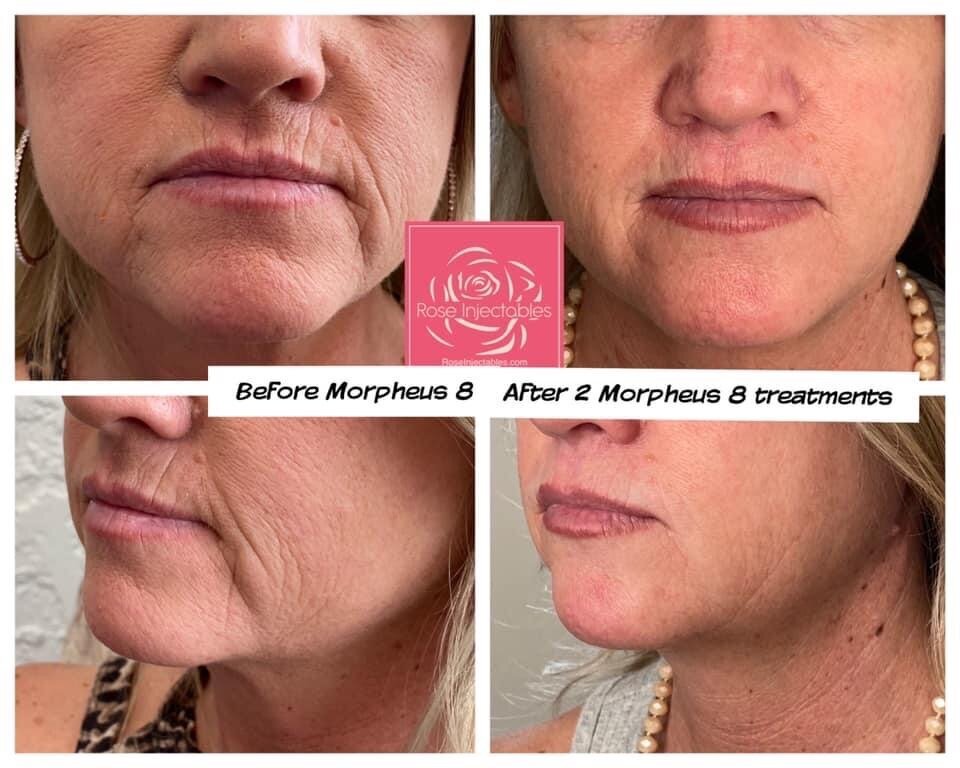 Morpheus8-by-Rose-Injectables-Before-and-After-Photos-68