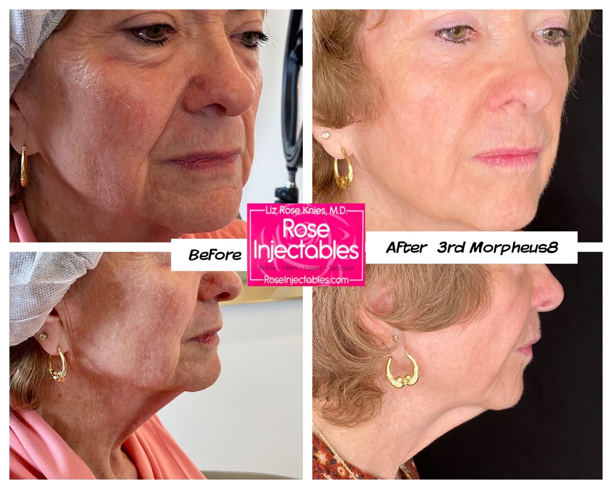 Morpheus8-by-Rose-Injectables-Before-and-After-Photos-30