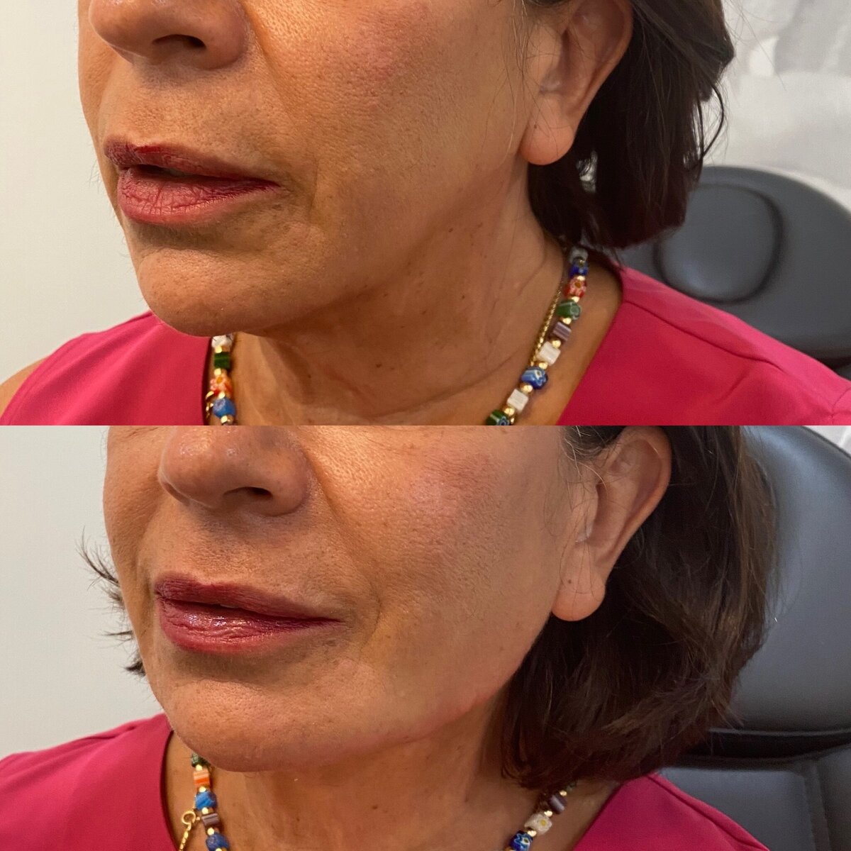 BalancedBeautyBotoxWestwood12