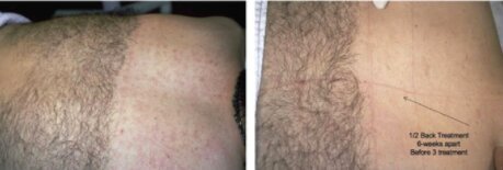 cervello-laser-hair-removal-device-before-after-1