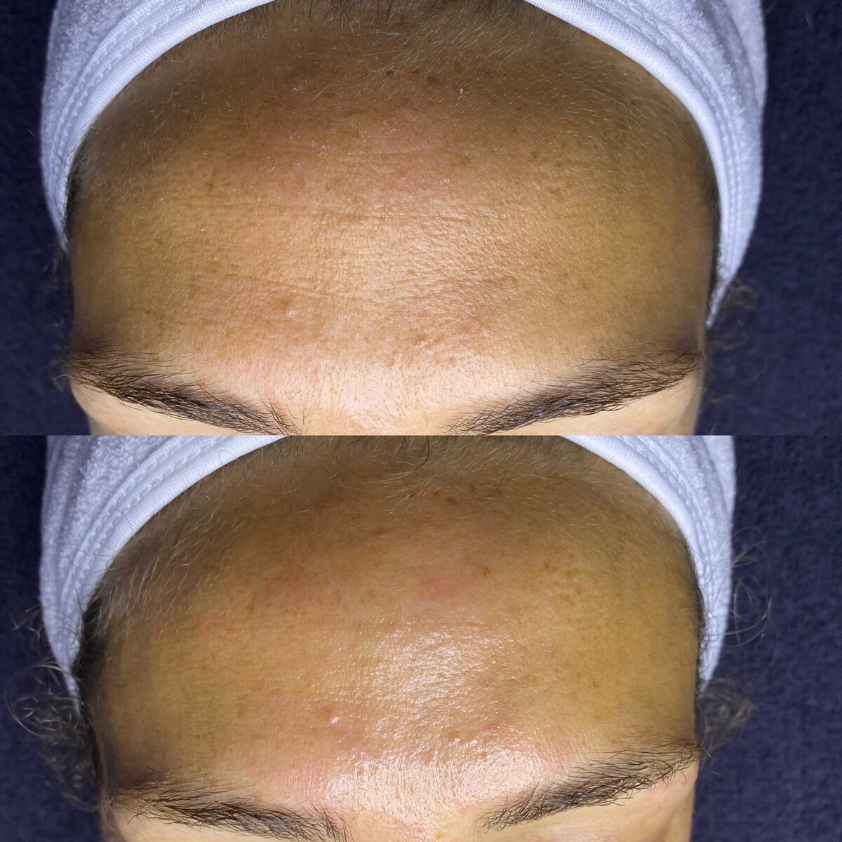 skin11