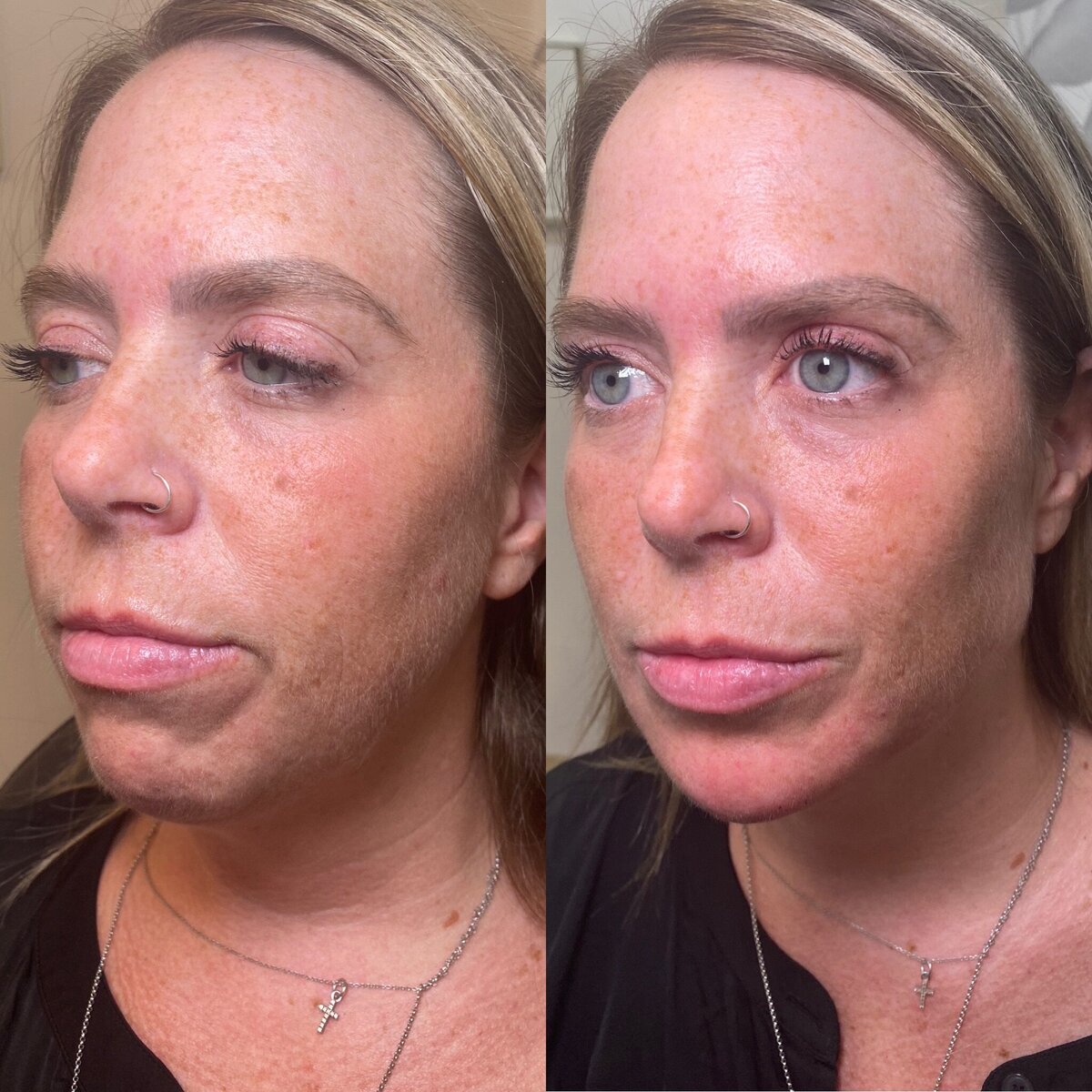 BalancedBeautyBotoxWestwood25