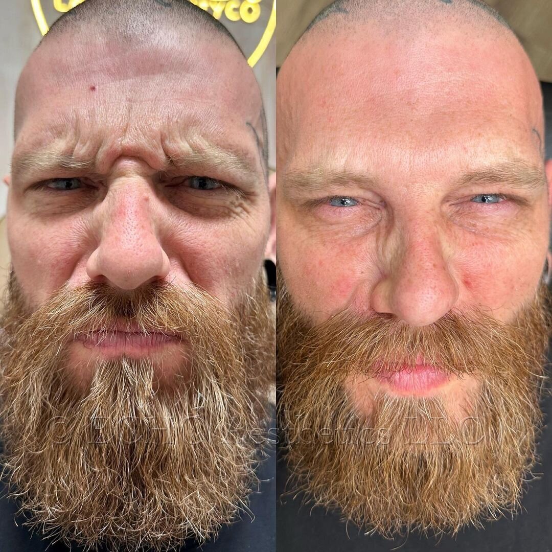 Botox