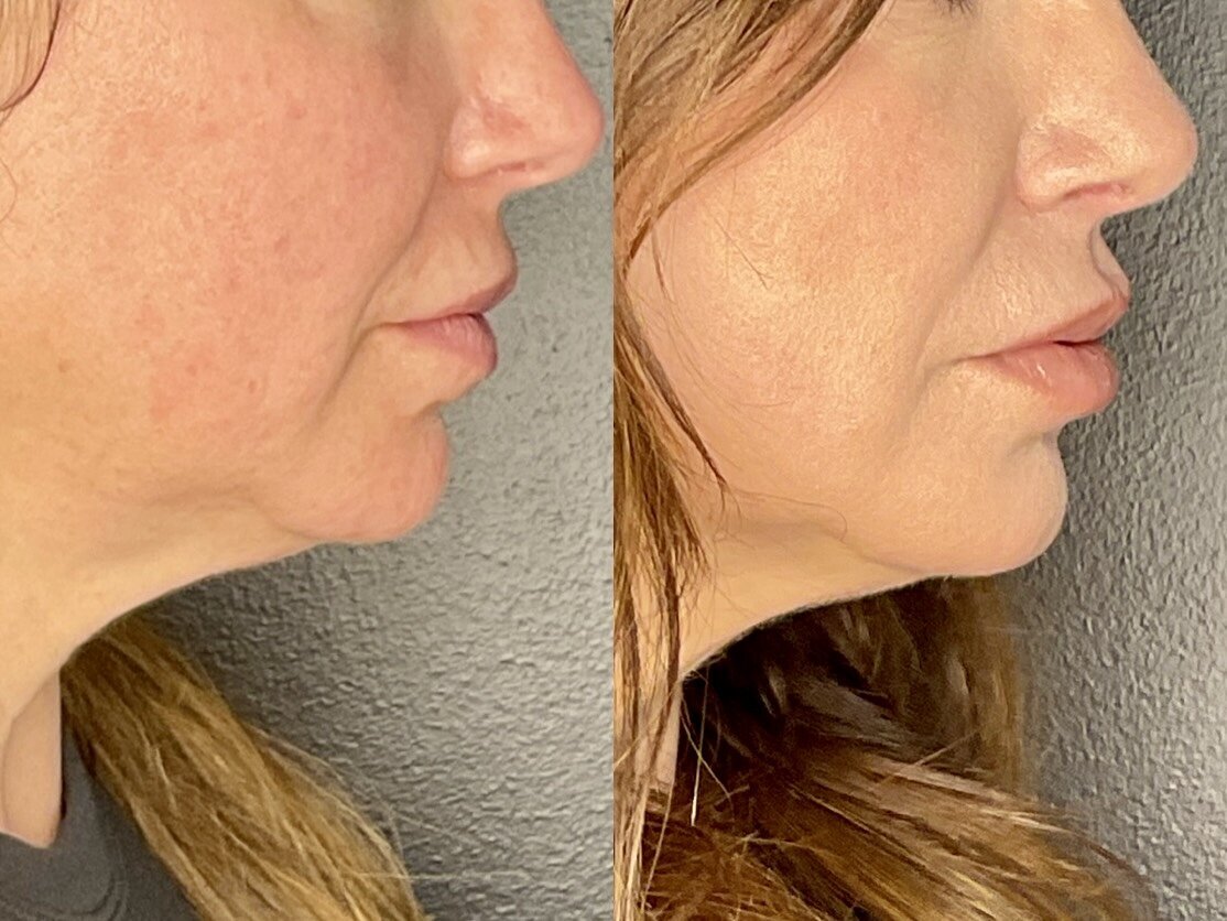 pre and post lip filler