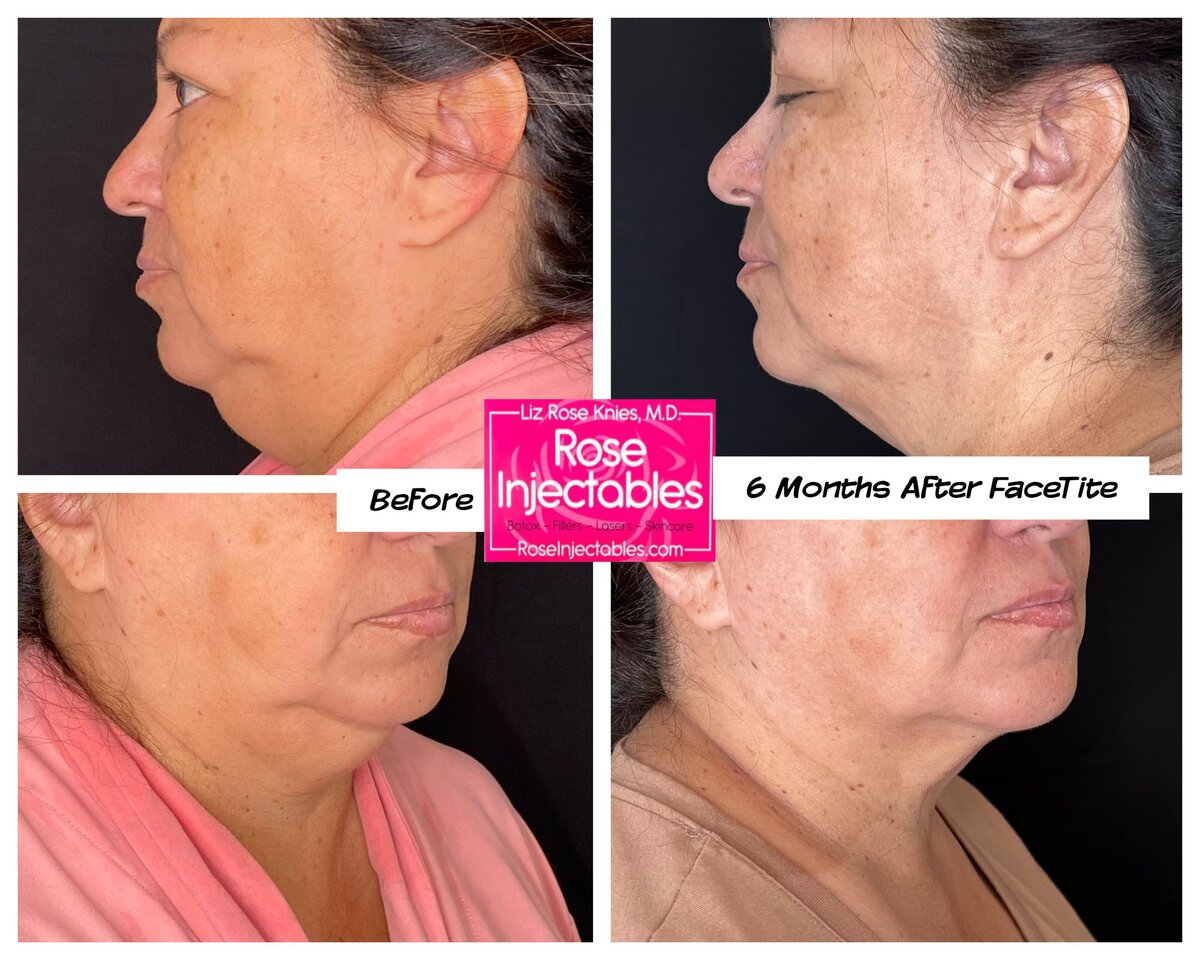 FaceTite-by-Rose-Injectables-Minimally-Invasive-Face-Contouring-Before-and-After-Photos-47