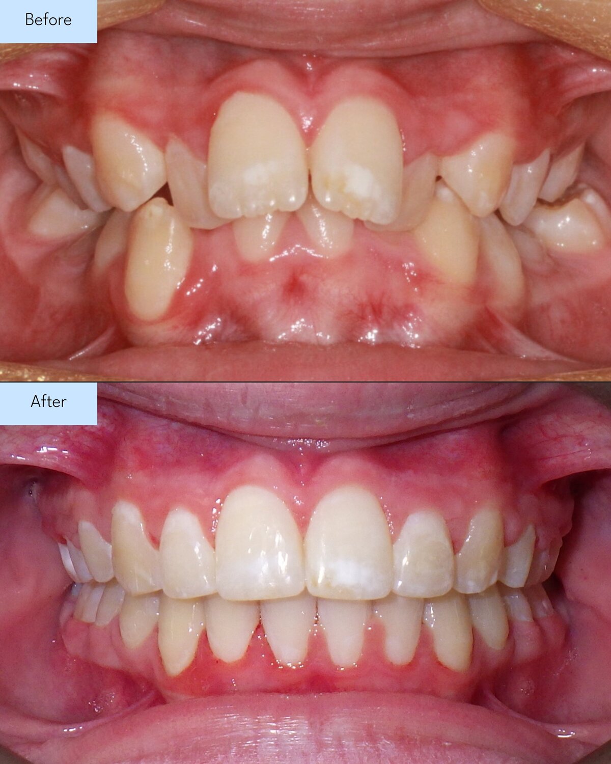 Before and after of Brooks & Templeton Orthodontics patient teeth transformation