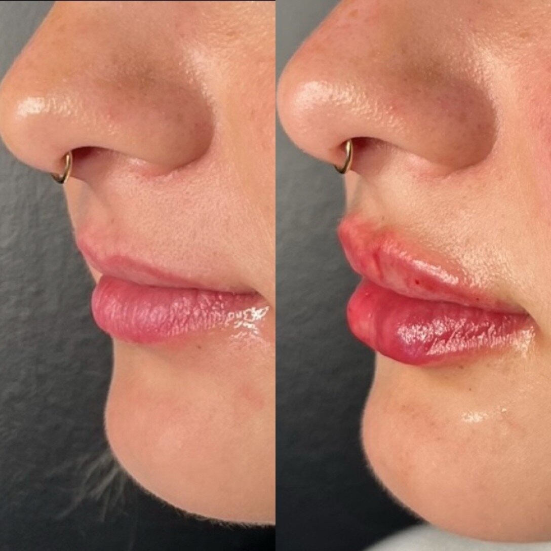 lip augmentation with 1 mL Revanesse Lips filler