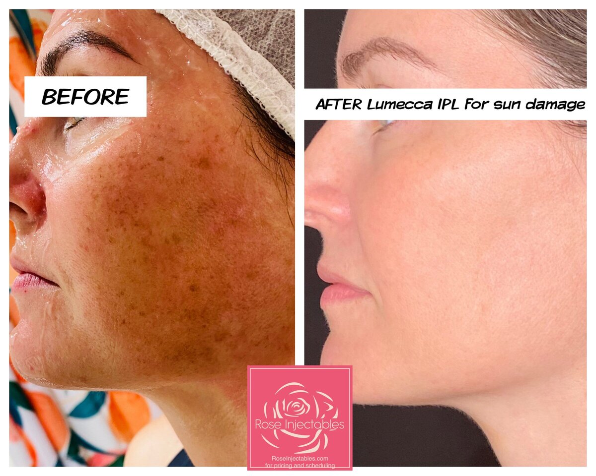 Lumecca-by-Rose-Injectables-Dark-Spot-Removal-Before-and-After-Photos-26