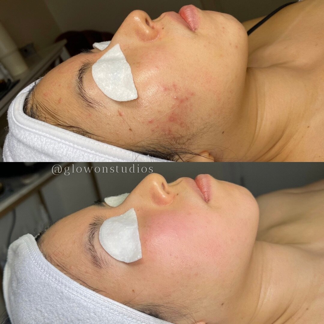 Glow-On-Studios-Before-After-Skincare-Sacramento-13
