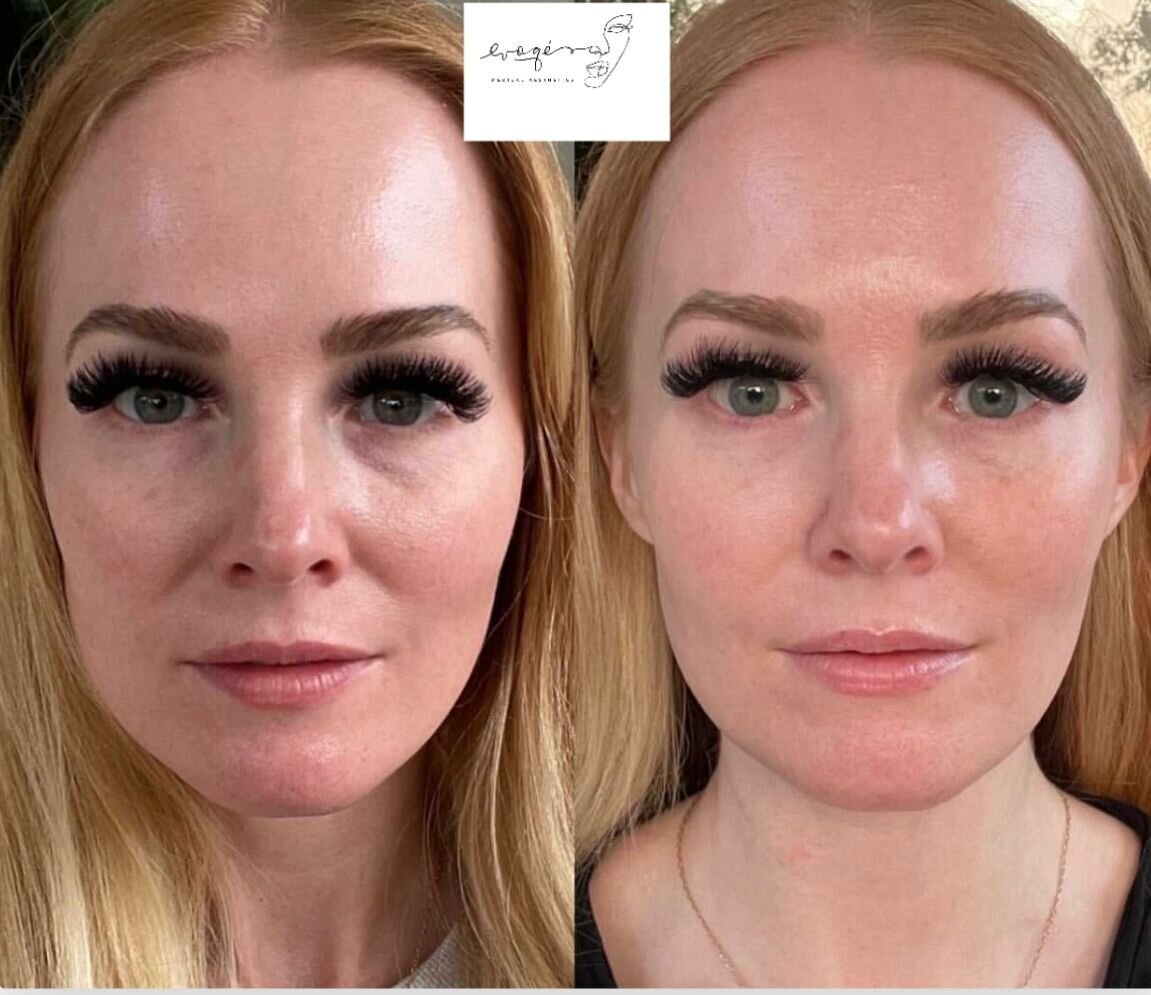 compressed-sculptra-before-after-01