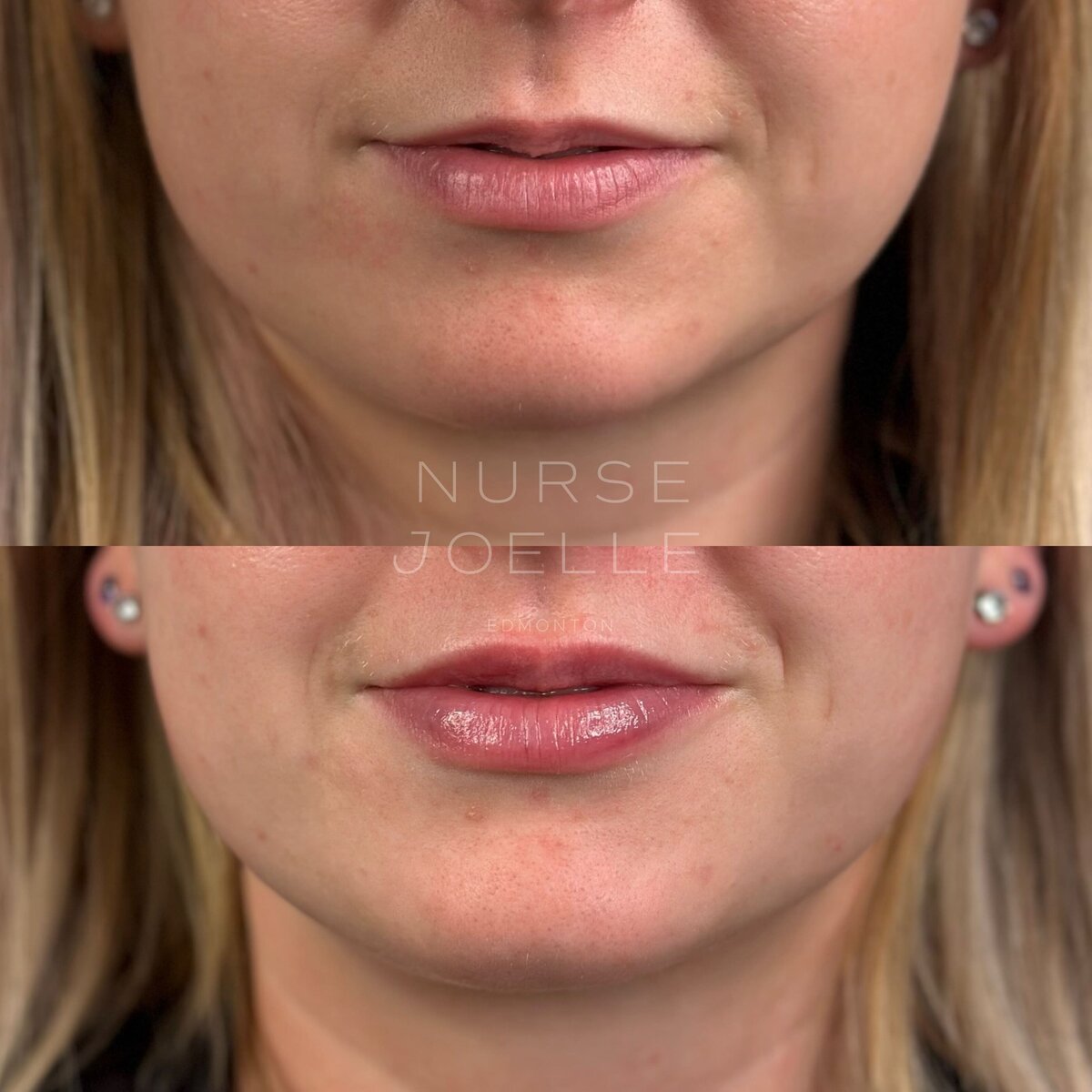 Nurse-Joelle-Dermal-Fillers-Before-After