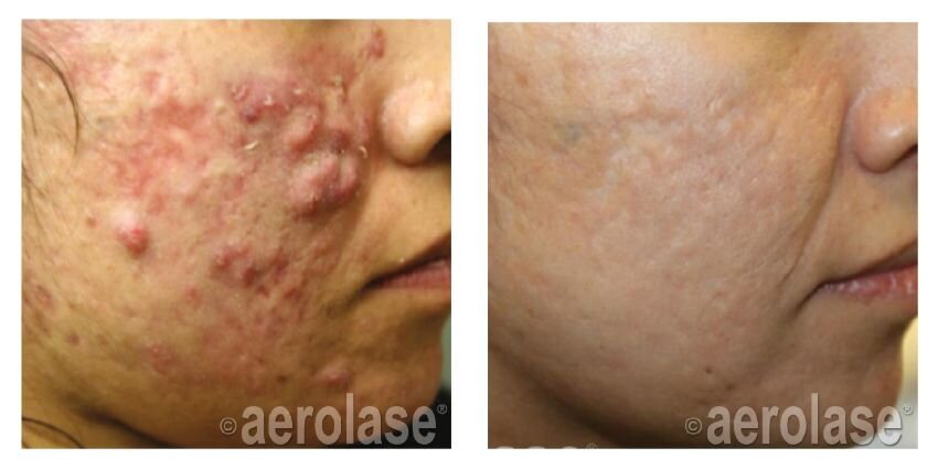 NeoClear Acne - After 5 Treatments - Michael Gold MD