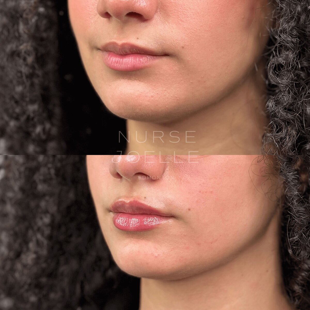 Nurse-Joelle-Cosmetic-Injectables-Before-and-After-12
