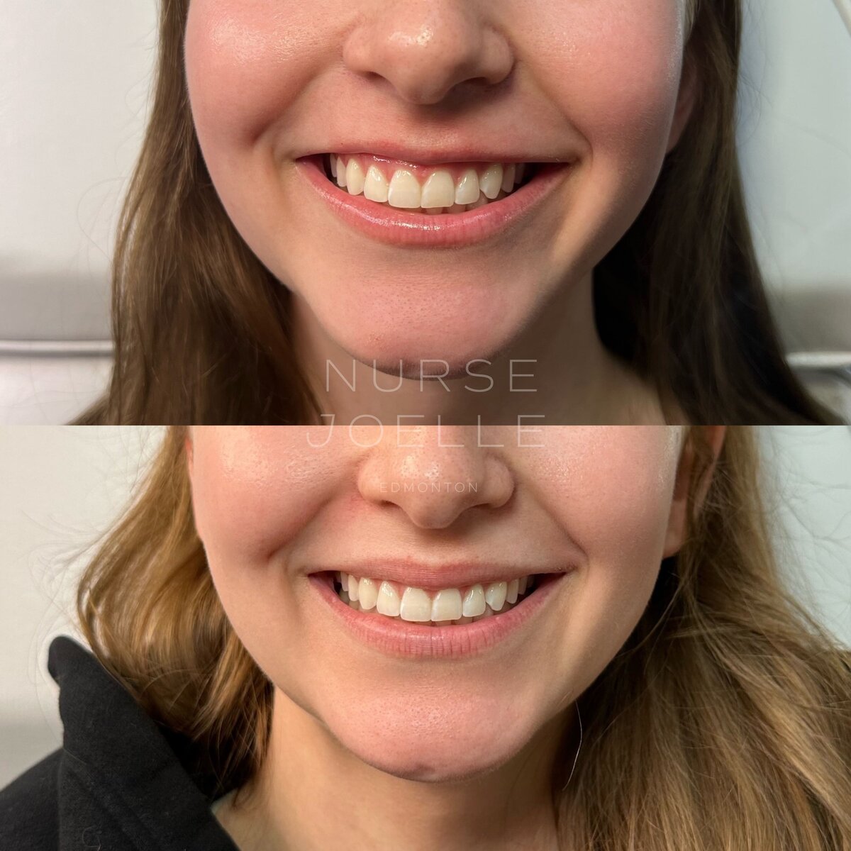 Nurse-Joelle-Fillers-Before-After