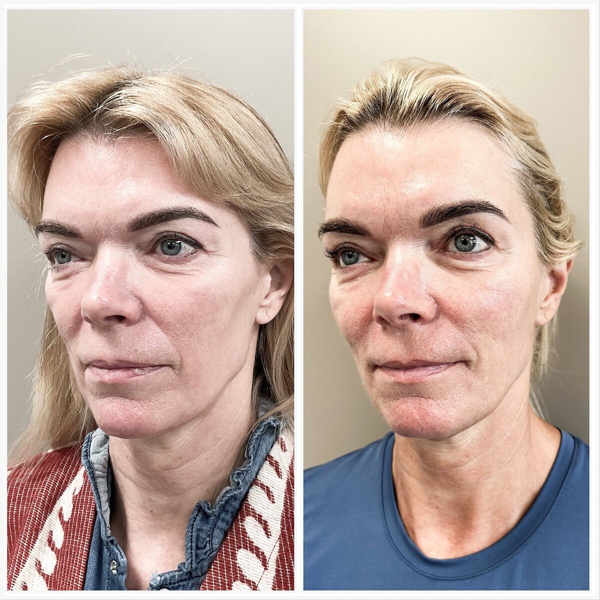 Liquid facelift door Lizenka Adriaanse cosmetisch arts Rotterdam3