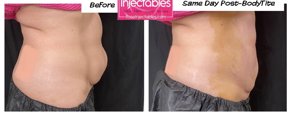 BodyTite-by-Rose-Injectables-Minimally-Invasive-Body-Contouring-Before-and-After-Photos-66