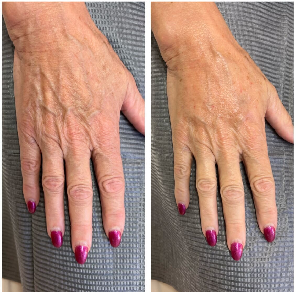 compressed-Hyperdilute-Radiesse-brand-and-before-after-12