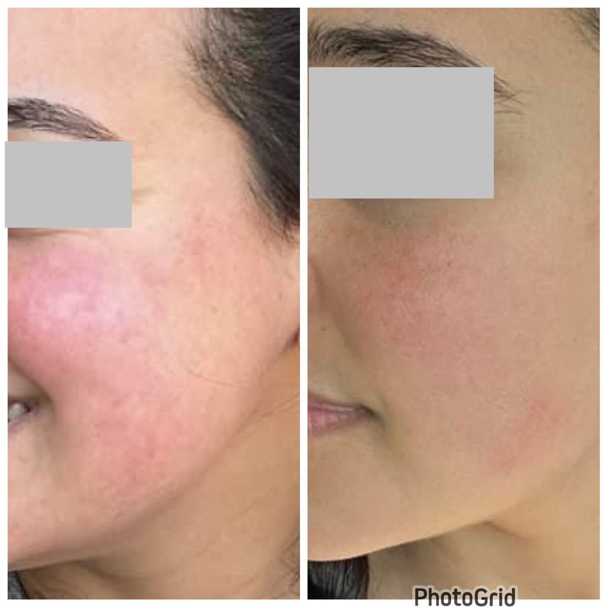 Client experiencing joy and self-assurance after achieving rosacea remission with holistic care.