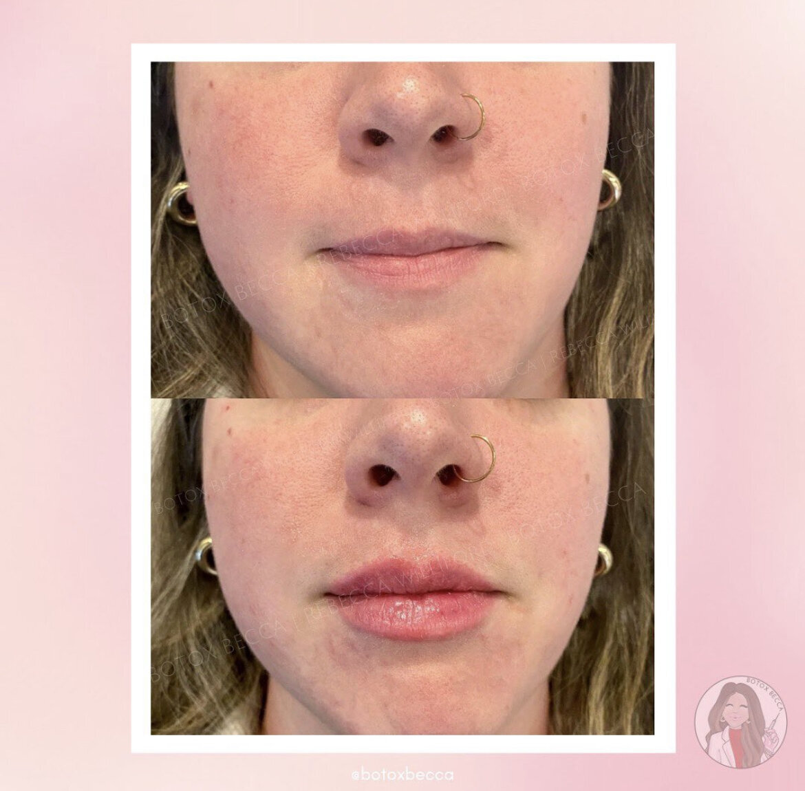 Lip Filler by Rebecca Williford at The Rae Clinic in Augusta, Georgia