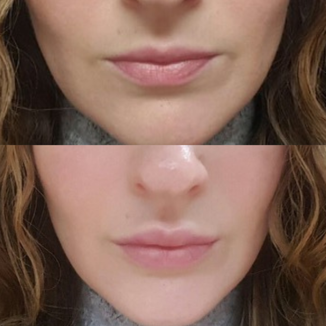 Lip enhancement with Juvederm(1)