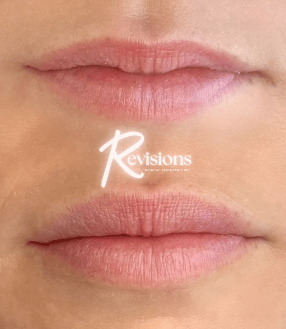 Healed_Lip_Filler_by_Ottawa_Nurse_Injector (1)