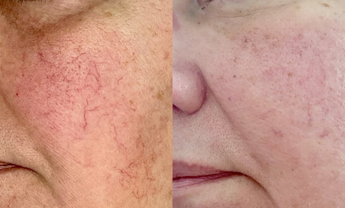 redness and blood vessel treatment with IPL laser