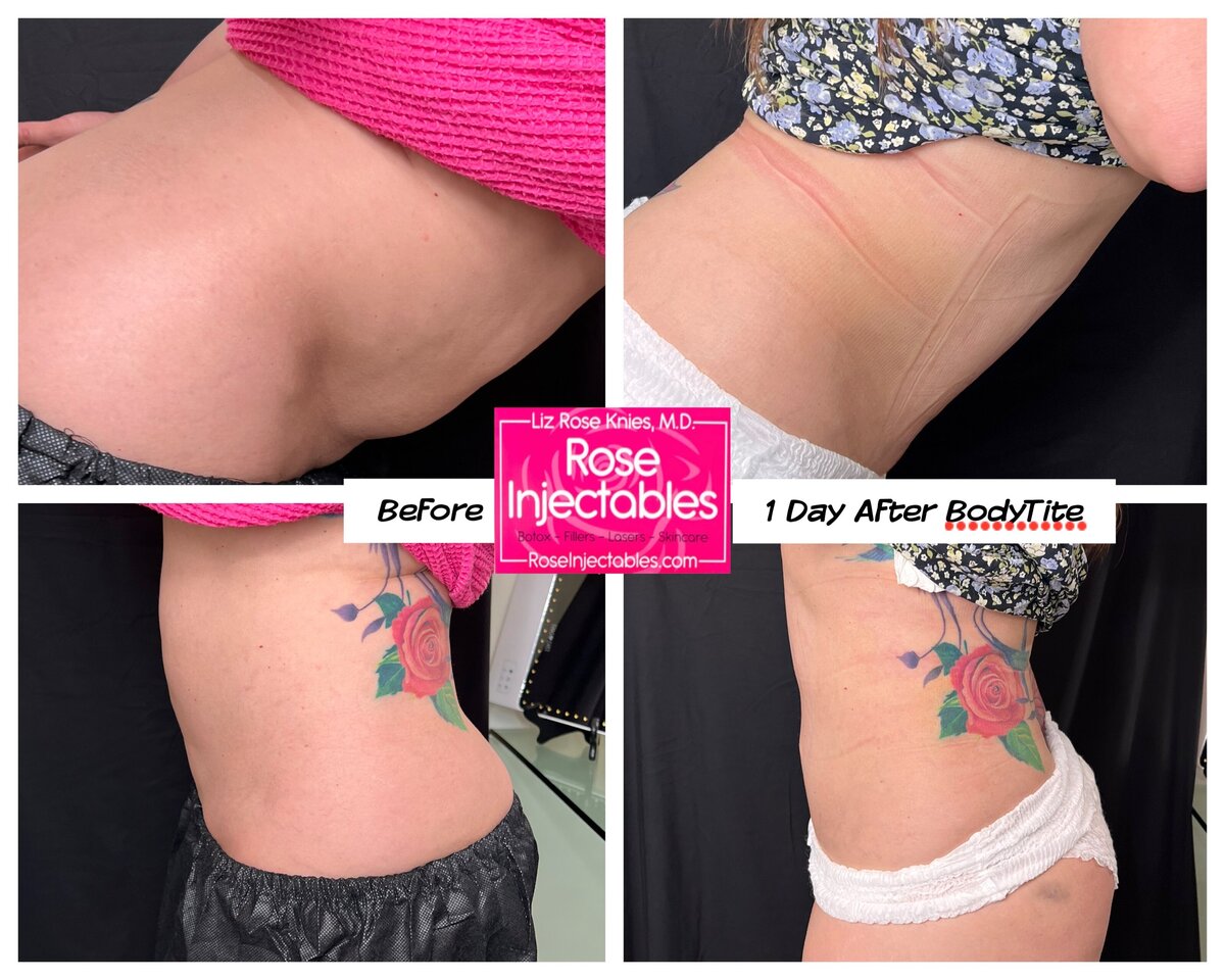 BodyTite-by-Rose-Injectables-Minimally-Invasive-Body-Contouring-Before-and-After-Photos-18