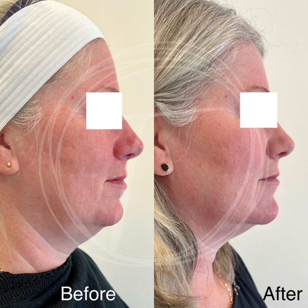 before:after results with look timeless - 6